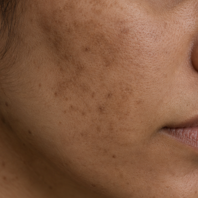Close-up of a woman's face showing a before-and-after style comparison of hyperpigmented facial spots on her cheek, with the spots significantly reduced or cleared.